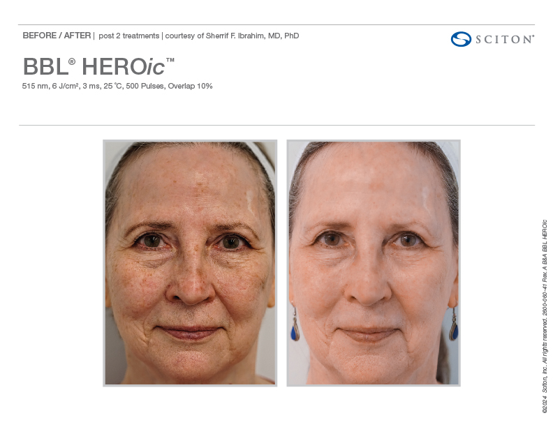 2600 060 41 Rev A B A Photos BBL HEROic binder