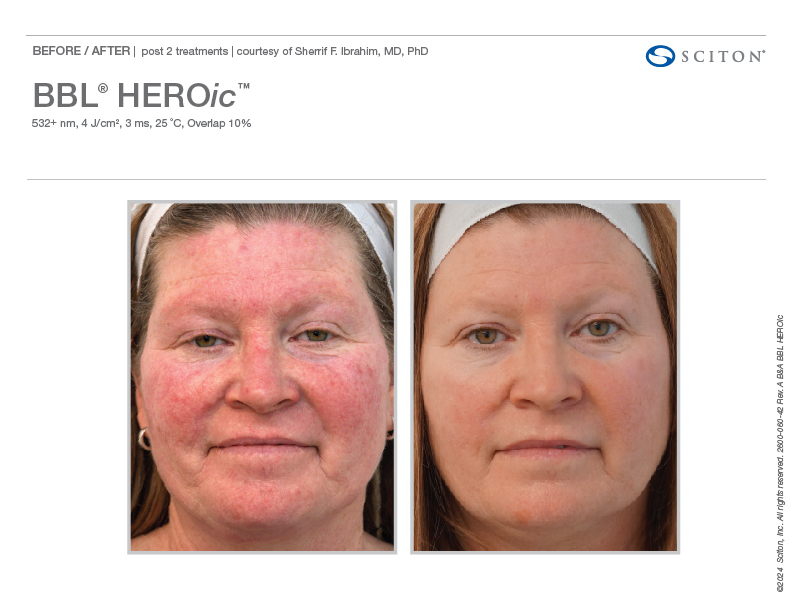 2600 060 42 Rev A B A Photos BBL HEROic binder